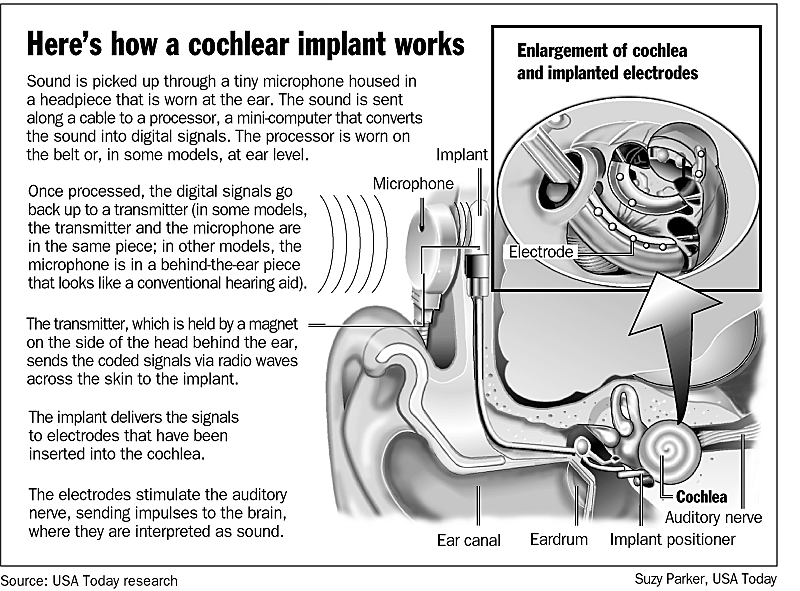 a cochlear implant works 2011